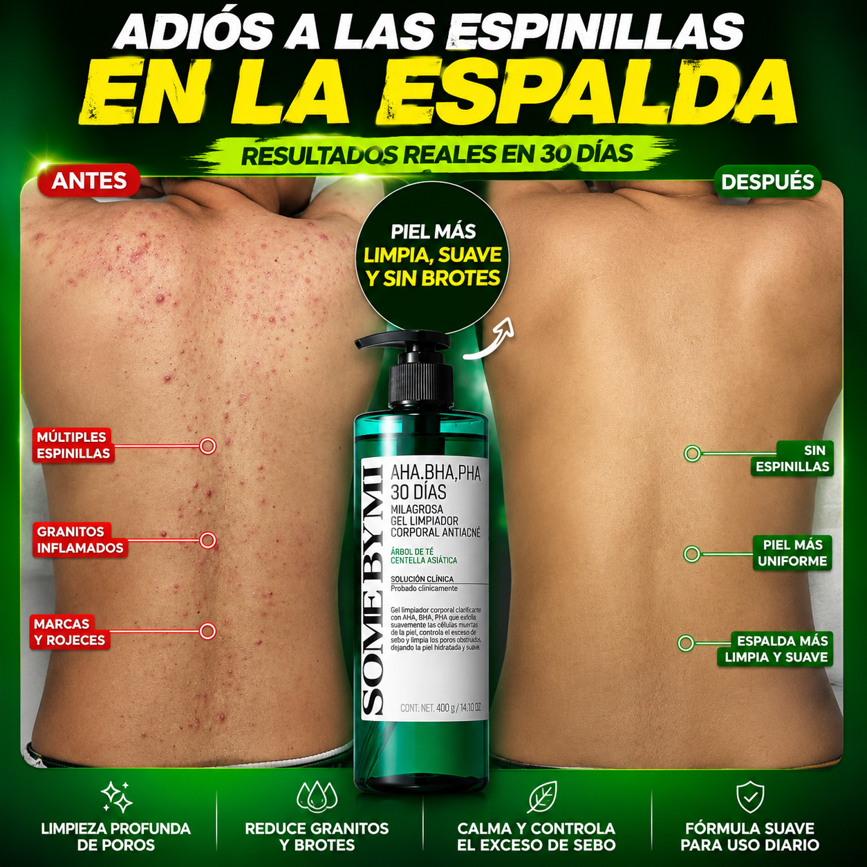 GEL DE DUCHA PARA ACNE CORPORAL PREMIUM