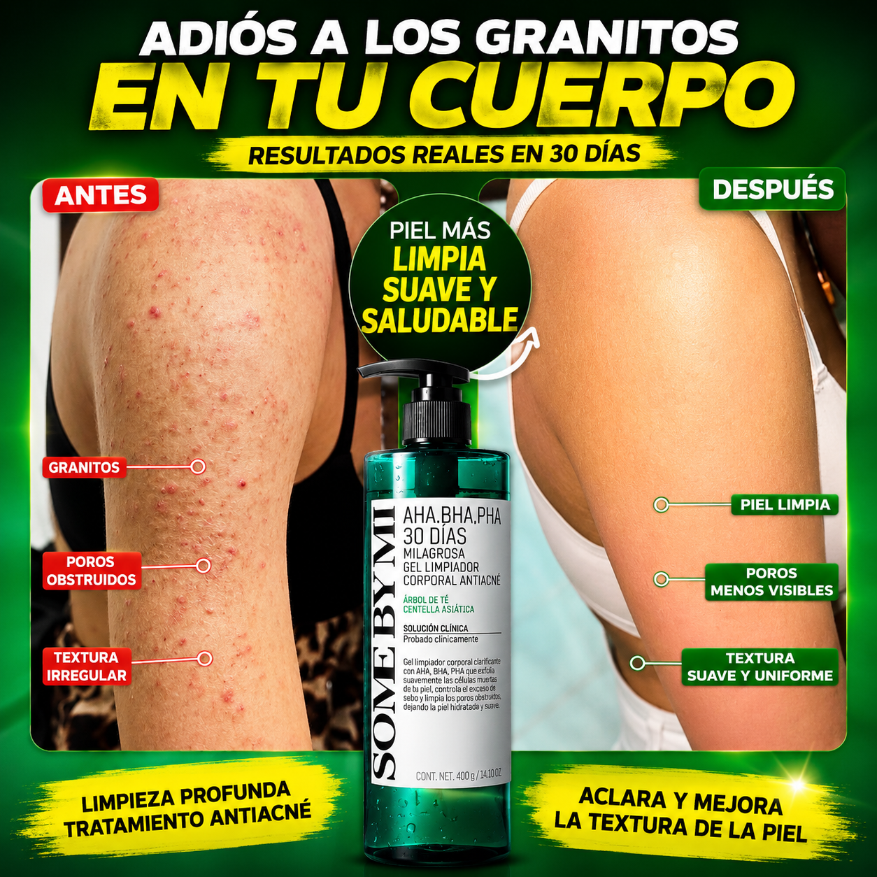 GEL DE DUCHA PARA ACNE CORPORAL PREMIUM